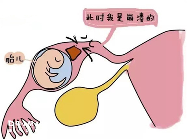 孕酮超過20不能確定宮外孕