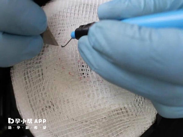 顯微取精術後7天能拆紗布