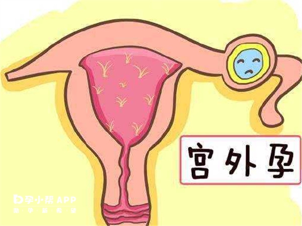 做b超可以排除宮外孕