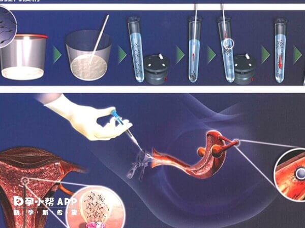 人工授精為什麼容易胎停