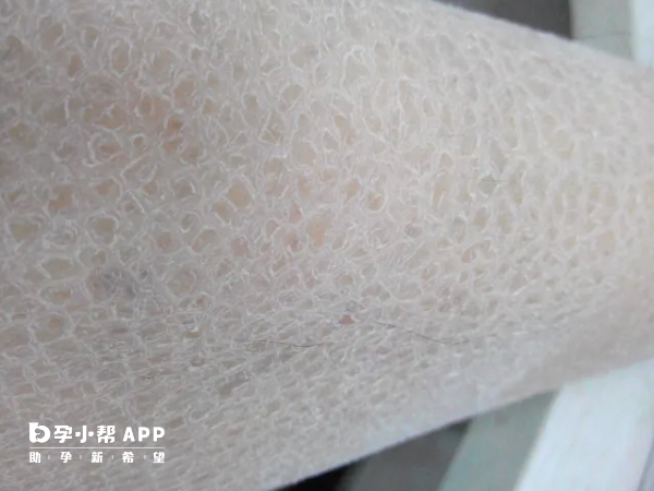 魚鱗病做三代試管嬰兒能避免遺傳