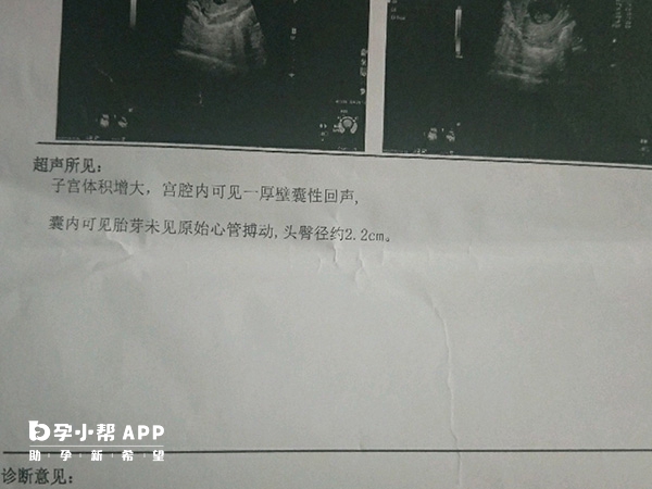 孕12周後會發生胎停