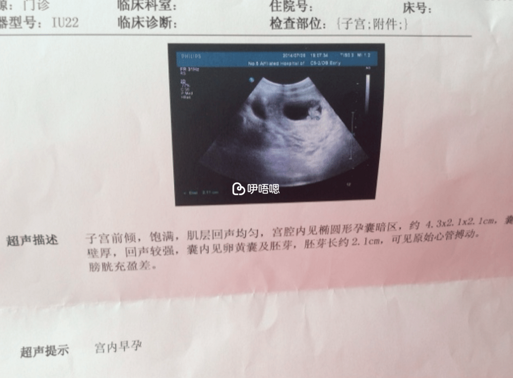 雙孕囊B超報告單