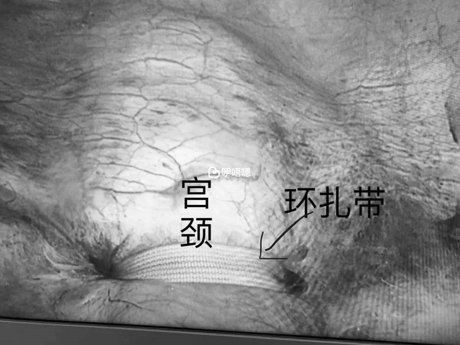宮頸環扎手術