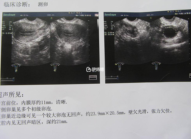 卵子質量改善方法