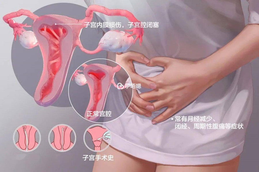 宮腔粘連會影響女性生育力