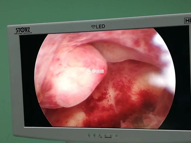 宮腔粘連需要做哪些檢查