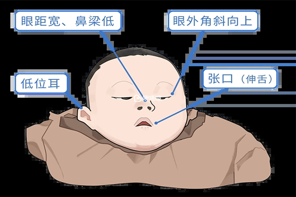 唐氏兒風險可以根據唐篩結果確定