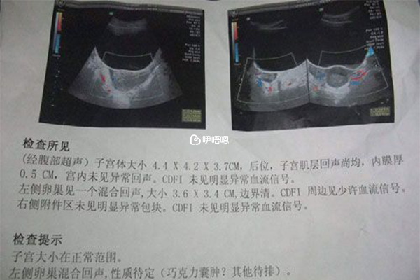 巧克力囊腫症狀