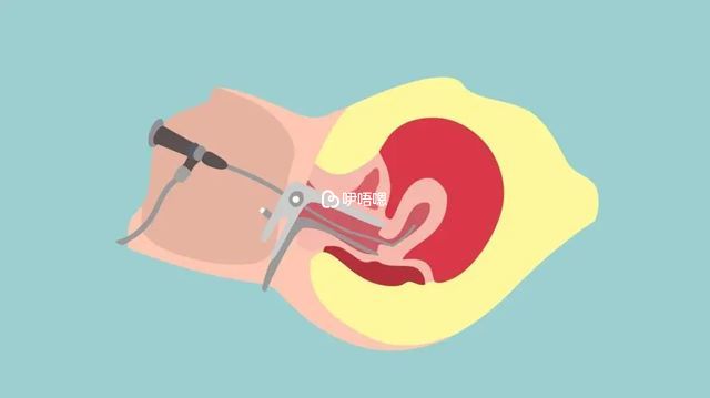 什麼是宮腔鏡檢查