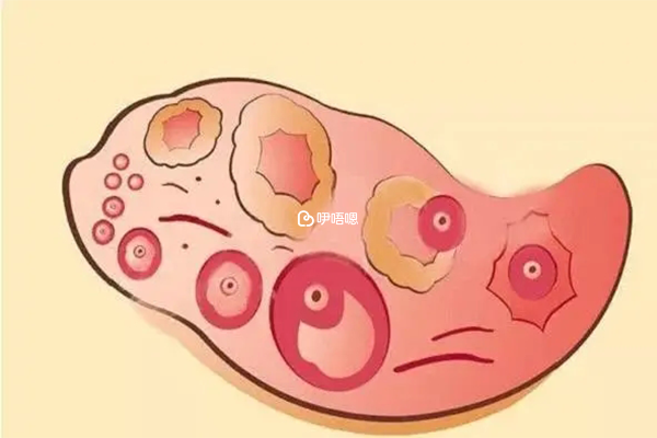 高泌乳素血癥也會造成促卵泡生成素偏高的現象