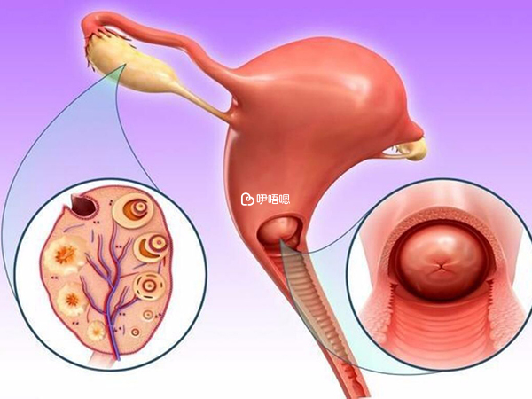 子宮肌瘤是婦產科常見的良性腫瘤