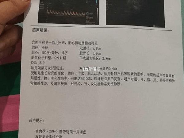 B超檢測