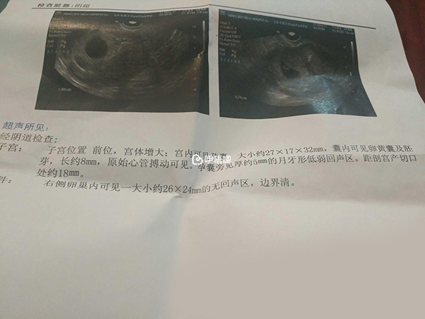 胎心胎芽是寶寶來到世上的證明