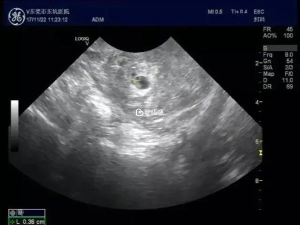 B超檢測出懷雙胞胎