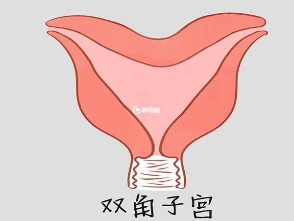 雙角子宮是先天性的子宮畸形疾病