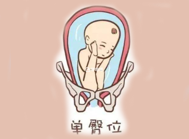 臀位提前破水很危險