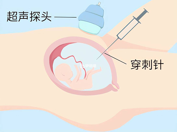 進一步檢查可選擇無創DNA或者羊水穿刺