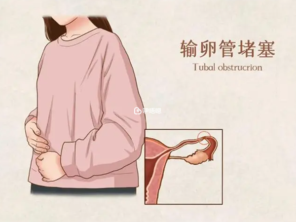 輸卵管堵塞可以通過試管助孕