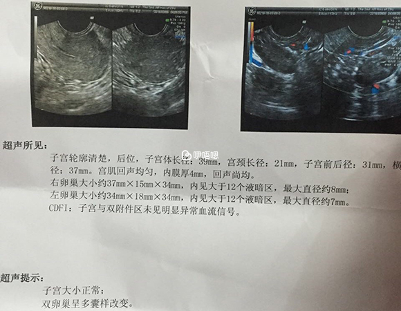 有卵巢水腫千萬不要急功近利當月移植