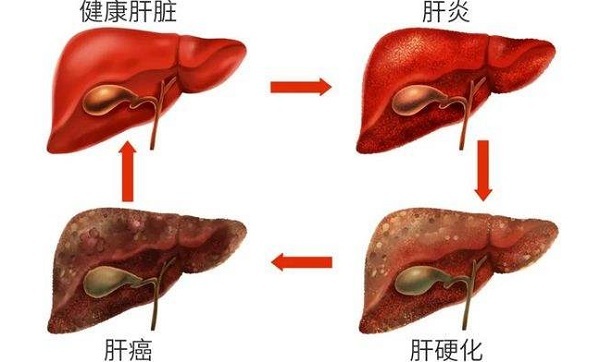 肝功能異常是抑那通最大副作用之一
