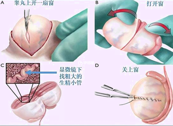 顯微取精操作步驟圖