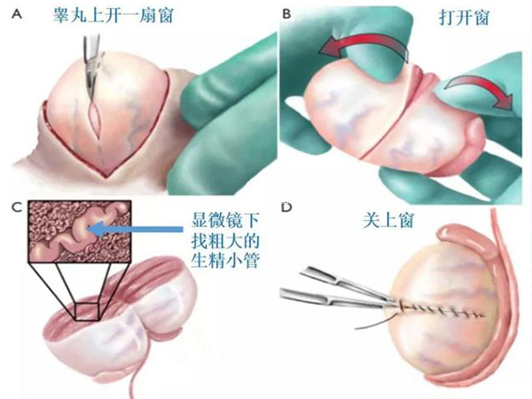 顯微取精術