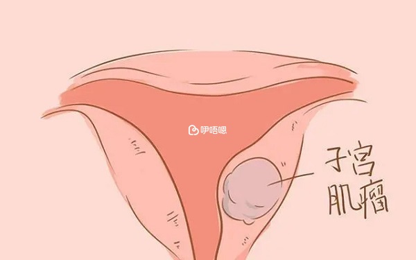 改善子宮肌瘤症狀可適當注射抑那通