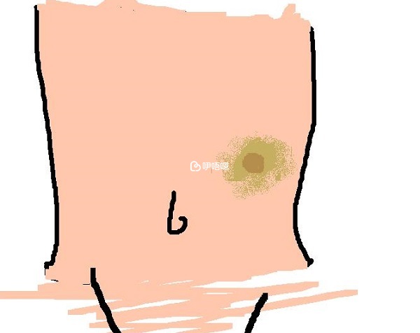 樂芮可以注射在腹部或大腿前