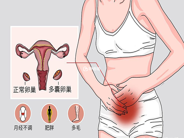 多囊可能導致無法受孕