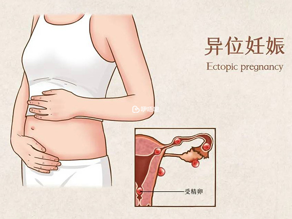 孕酮過低需要排出宮外孕