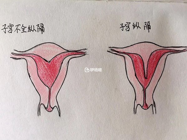 縱隔子宮影響胎兒發育
