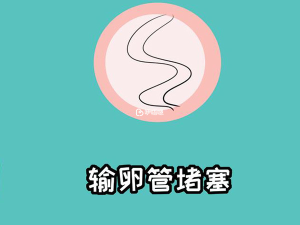 輸卵管堵塞