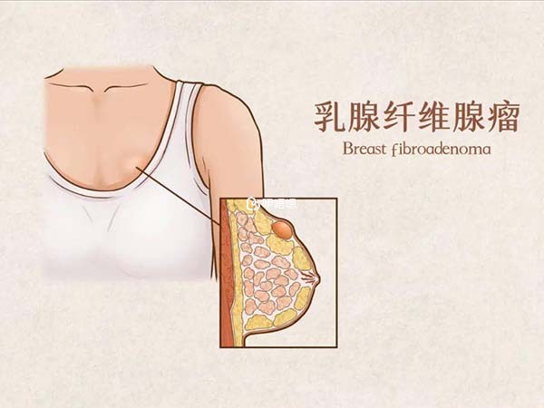 第三次移植遇上乳腺纖維瘤