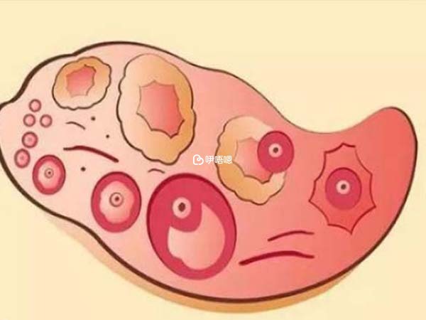 卵子變生理囊腫