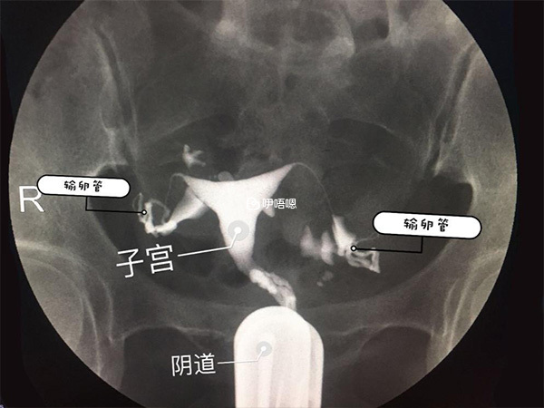輸卵管照影