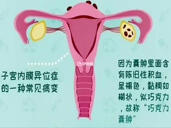 檢查出患有巧克力囊腫