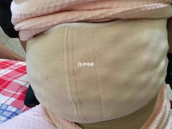 取卵可能引起反覆腹水