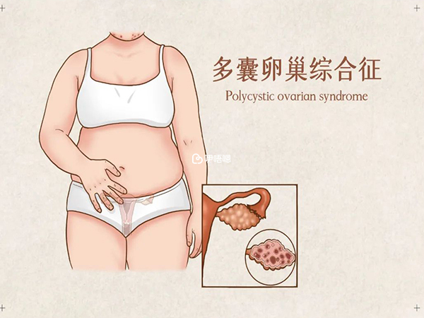 多囊下的備孕