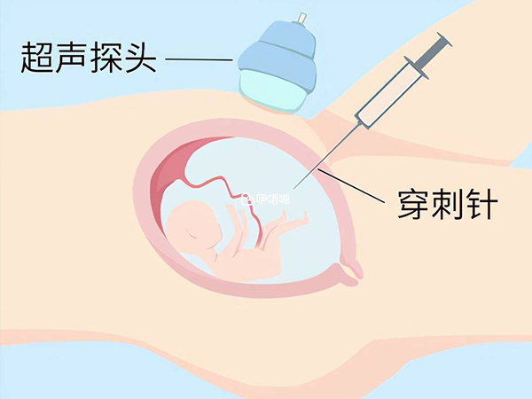 羊水穿刺手術