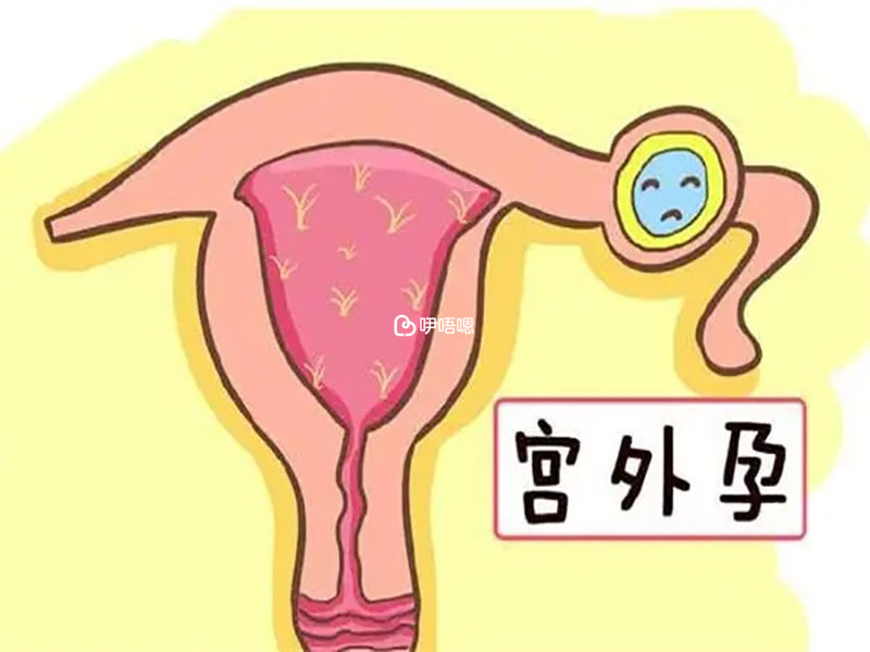 避免宮外孕
