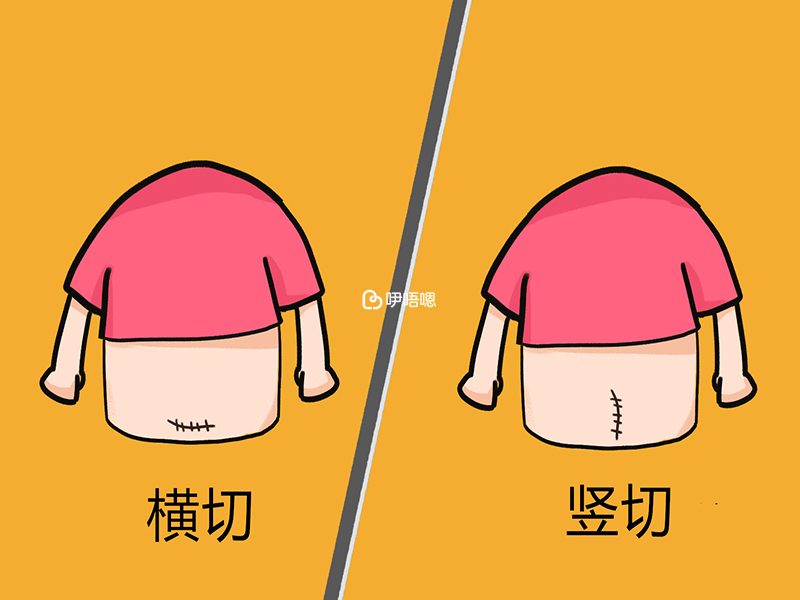 剖腹產不會影響壽命