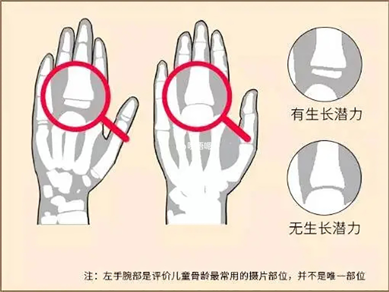識別孩子骨齡片方法