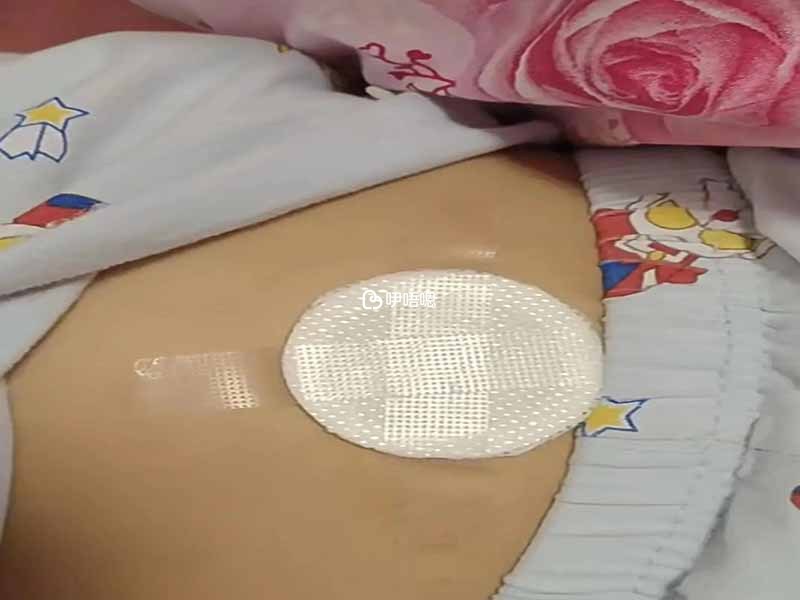 丁桂兒臍貼是一種治療小兒腹瀉腹痛的藥物