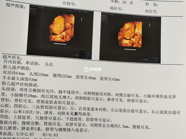 四維彩超檢查單