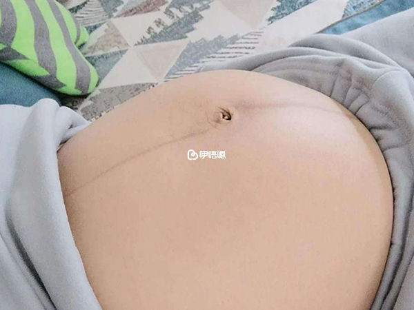 妊娠線直又長可能懷男孩