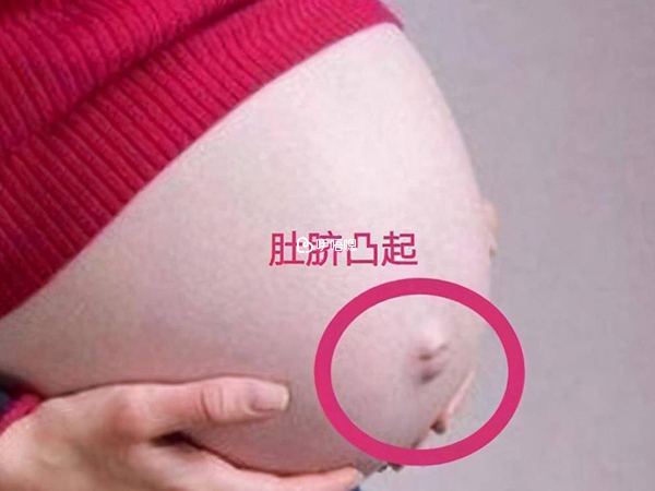 肚臍外凸懷男孩機率大