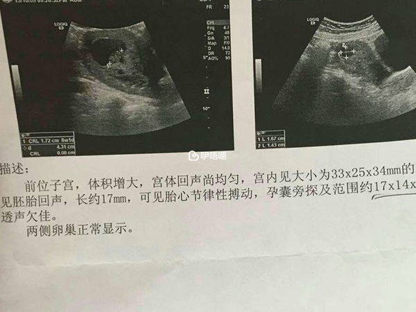 醫院b超檢查單