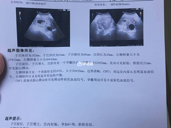 超聲檢查結果單