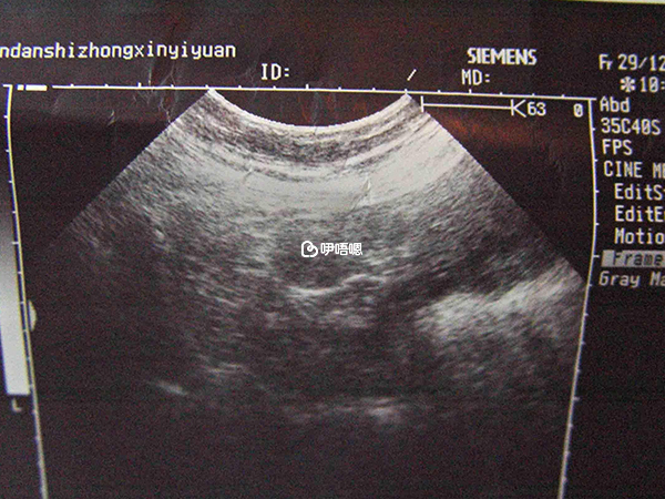 超聲檢查影像